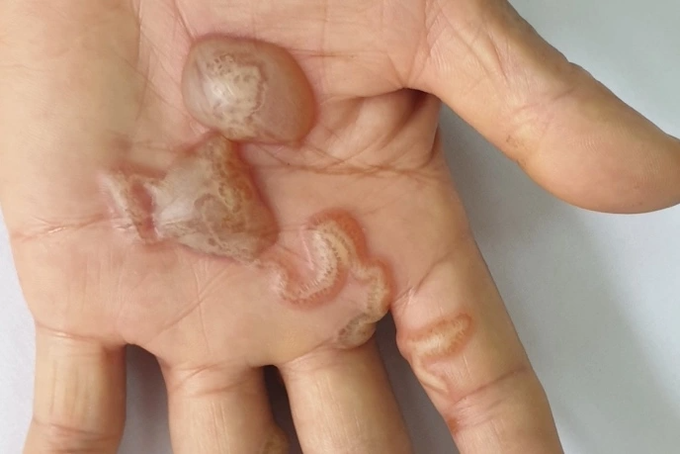 Bị ngứa 10 năm mới biết giun từ chó mèo đào hầm trong da - 1
